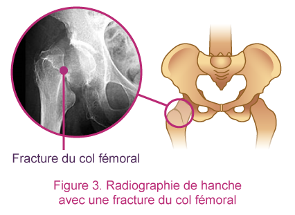 Radiographie de hanche avec une fracture du col fémoral