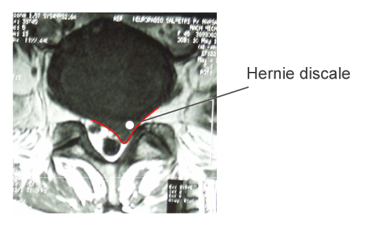 Hernie discale - IRM