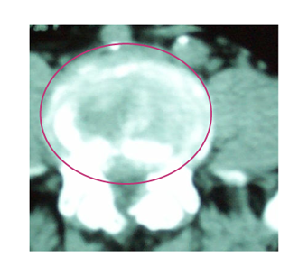 Protusion discale vue au scanner