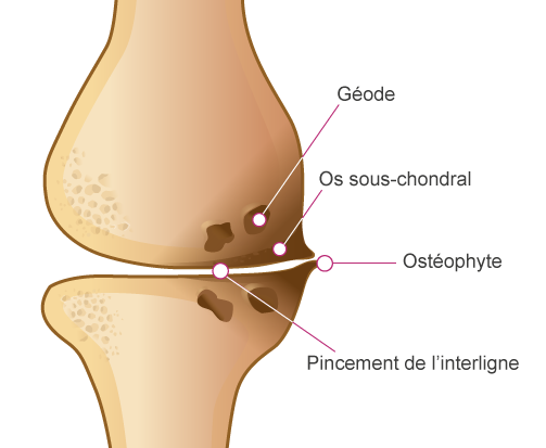 Diagnostic de l'arthrose du genou, comment reconnaître l'arthrose du genou ?