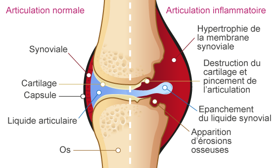 Articulation normale & articulation inflammatoire