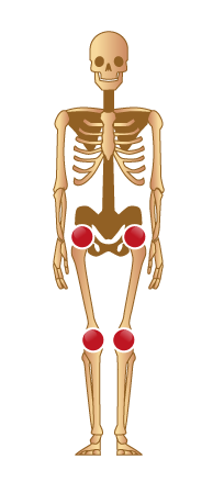 Arthrites et membres inférieurs